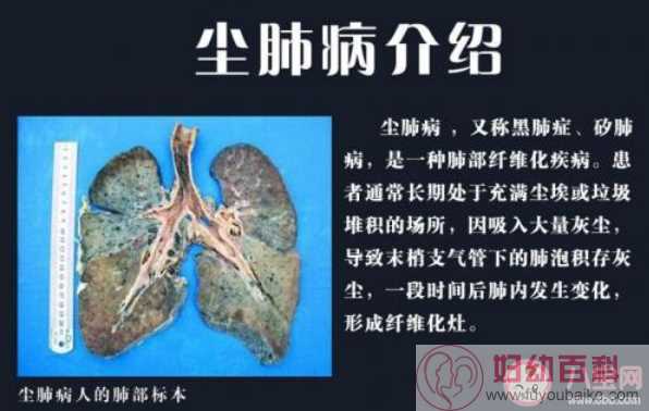 尘肺病到底有多严重 尘肺病如何预防
