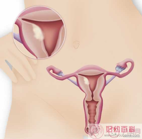 孕妇子宫肌瘤可以在剖宫产时一起拿掉吗 孕期子宫肌瘤是保守观察还是治疗