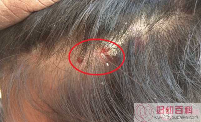 头皮上抠下的小颗粒是什么 如何正确护理头皮