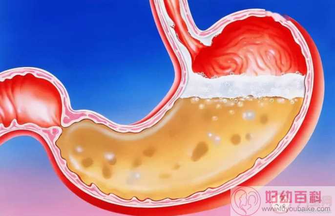 胃食管反流病为什么一停药就复发 如何预防胃食管反流复发