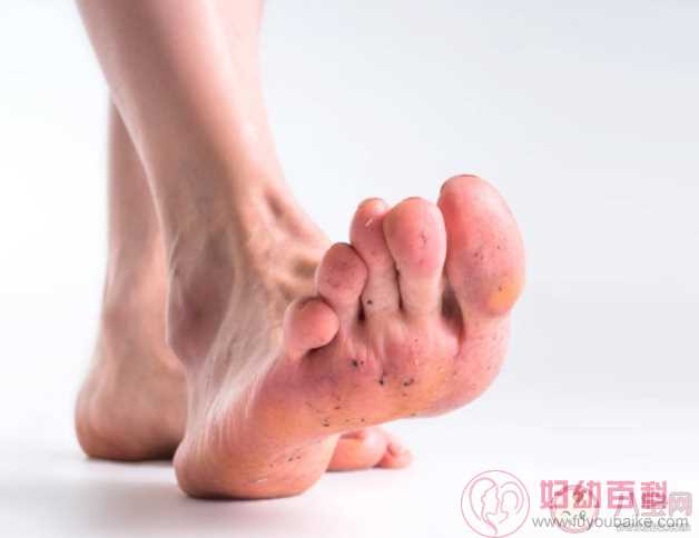 天天洗脚换袜子为什么还是脚臭 如何处理及预防脚臭
