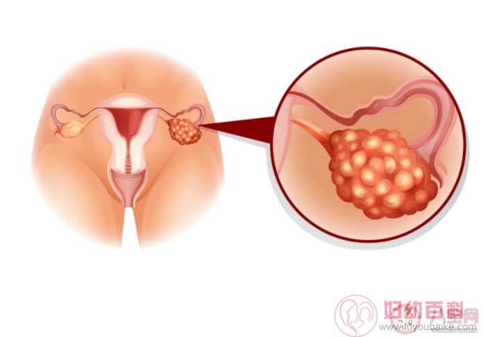 查出卵巢巧克力囊肿一定要手术吗 卵巢巧克力囊肿对生育危害有多大