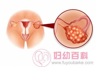 查出卵巢巧克力囊肿一定要手术吗 卵巢巧克力囊肿对生育危害有多大