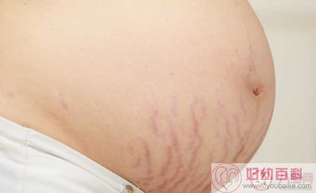 妊娠纹的发展过程是怎样的 祛除妊娠纹的产品真的有效吗