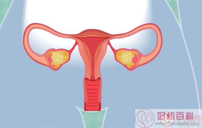 子宫内膜异位症可以预防吗 子宫内膜异位症高危人群有哪些