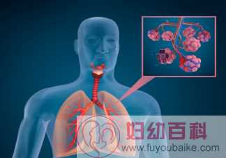 肺磨玻璃结节会演变成肺癌吗 什么是肺部磨玻璃结节