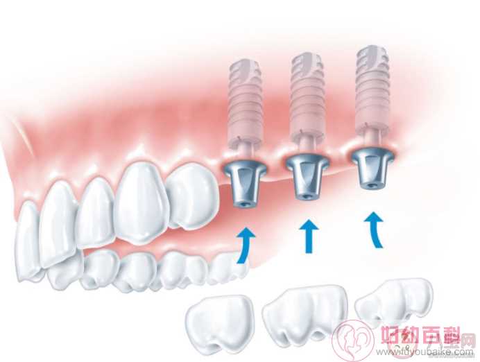 拔牙后的洞一直塞食物怎么办 拔牙后的牙洞多久能长好