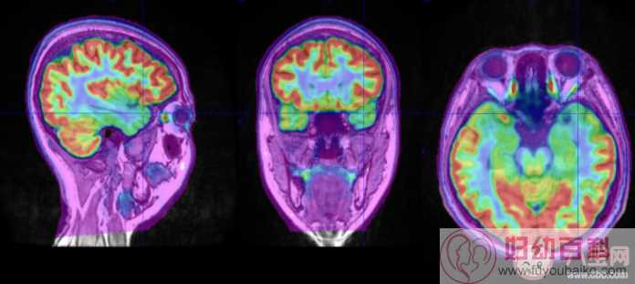 为什么癫痫病人要频繁检查脑电图 不同类型脑电图区别介绍