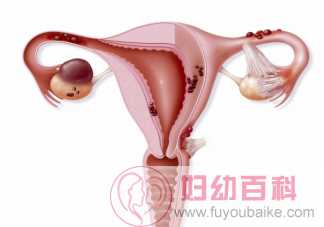 有卵巢囊肿可以怀孕吗 没有性生活也会得卵巢囊肿吗