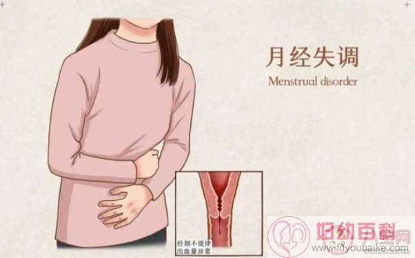 多囊卵巢综合症有多隐蔽 该如何应对多囊卵巢综合症