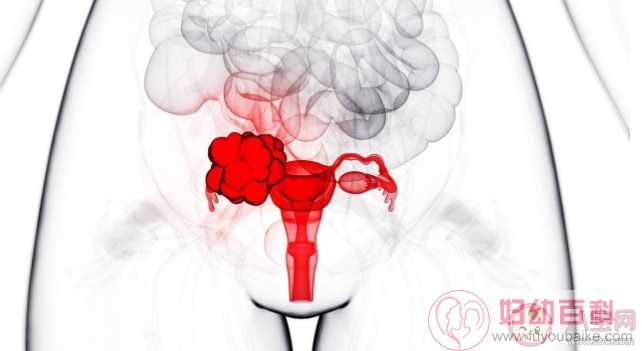 卵巢癌容易复发吗 哪些女性是卵巢癌高危人群