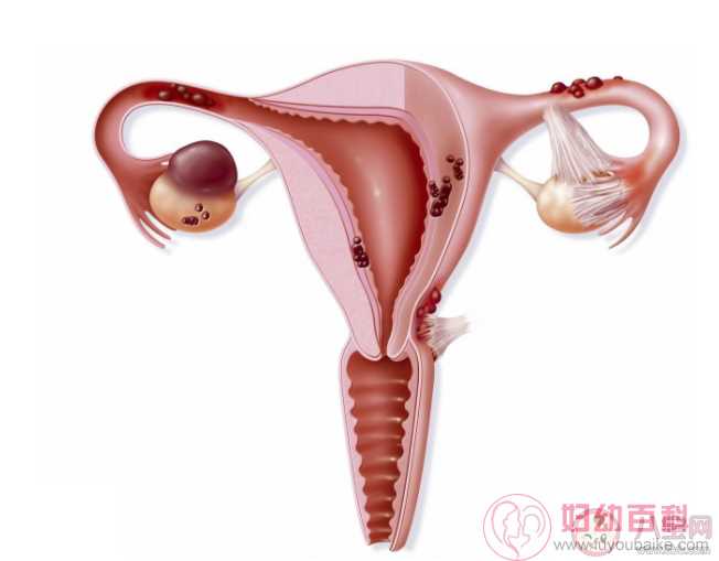 患有多囊卵巢综合征就代表不孕吗 没有生育需求多囊不用治疗吗